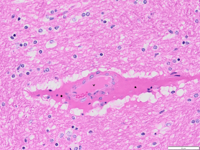 Histology of enterotoxaemia brain lesion.