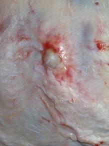 abscess in flank